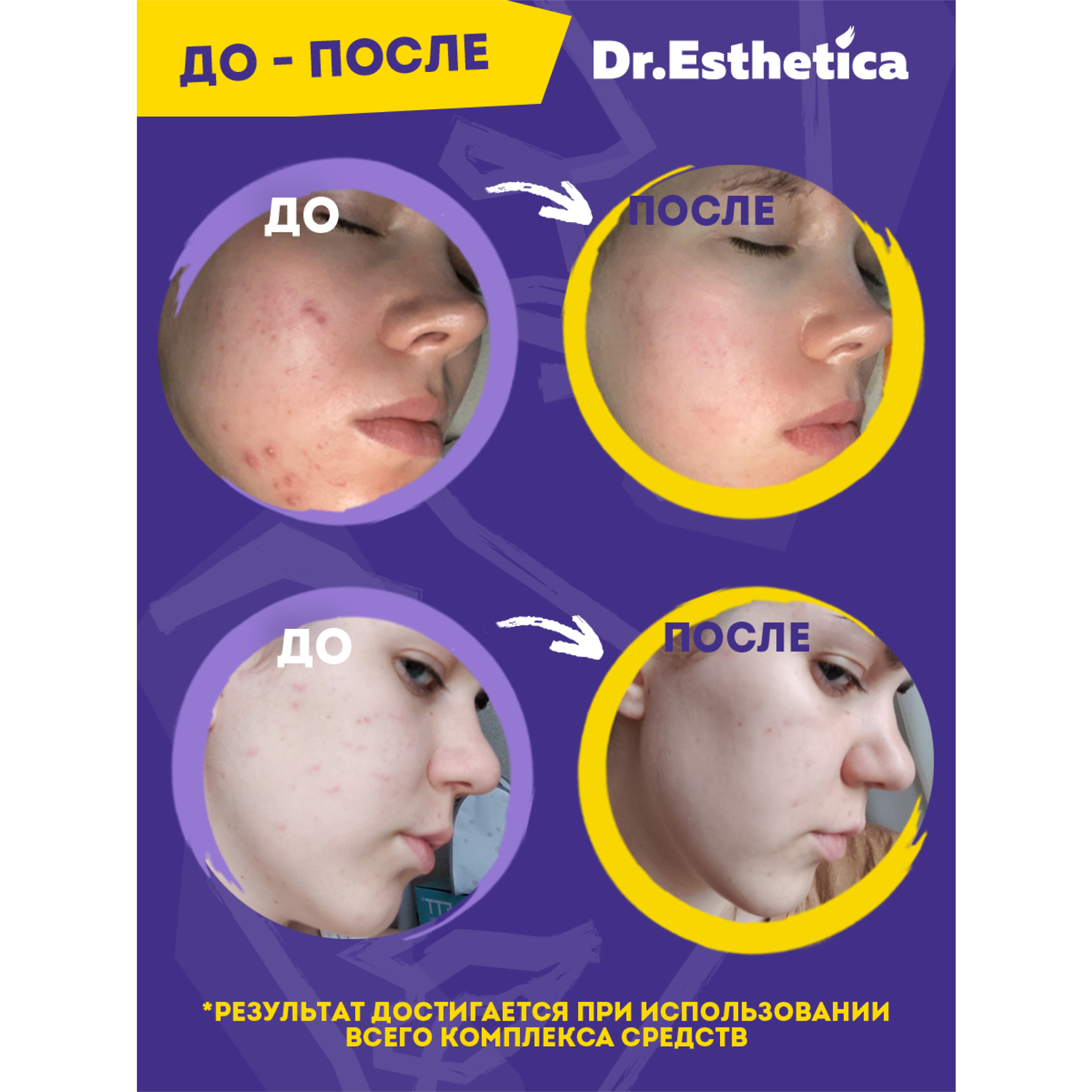 фото Гель-актив dr. esthetica no acne teens 20 мл