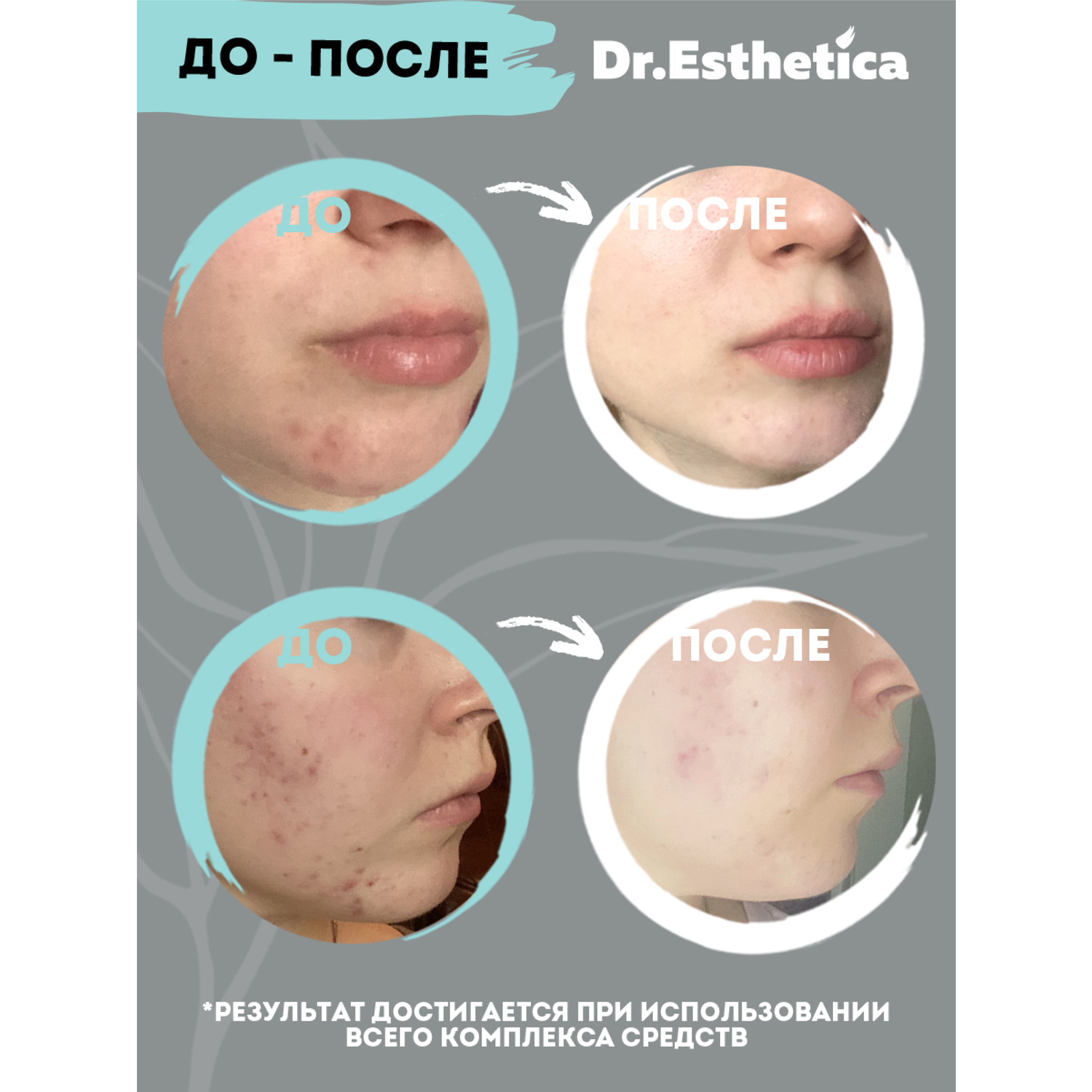 фото Крем-баланс dr. esthetica no acne adults 50 мл