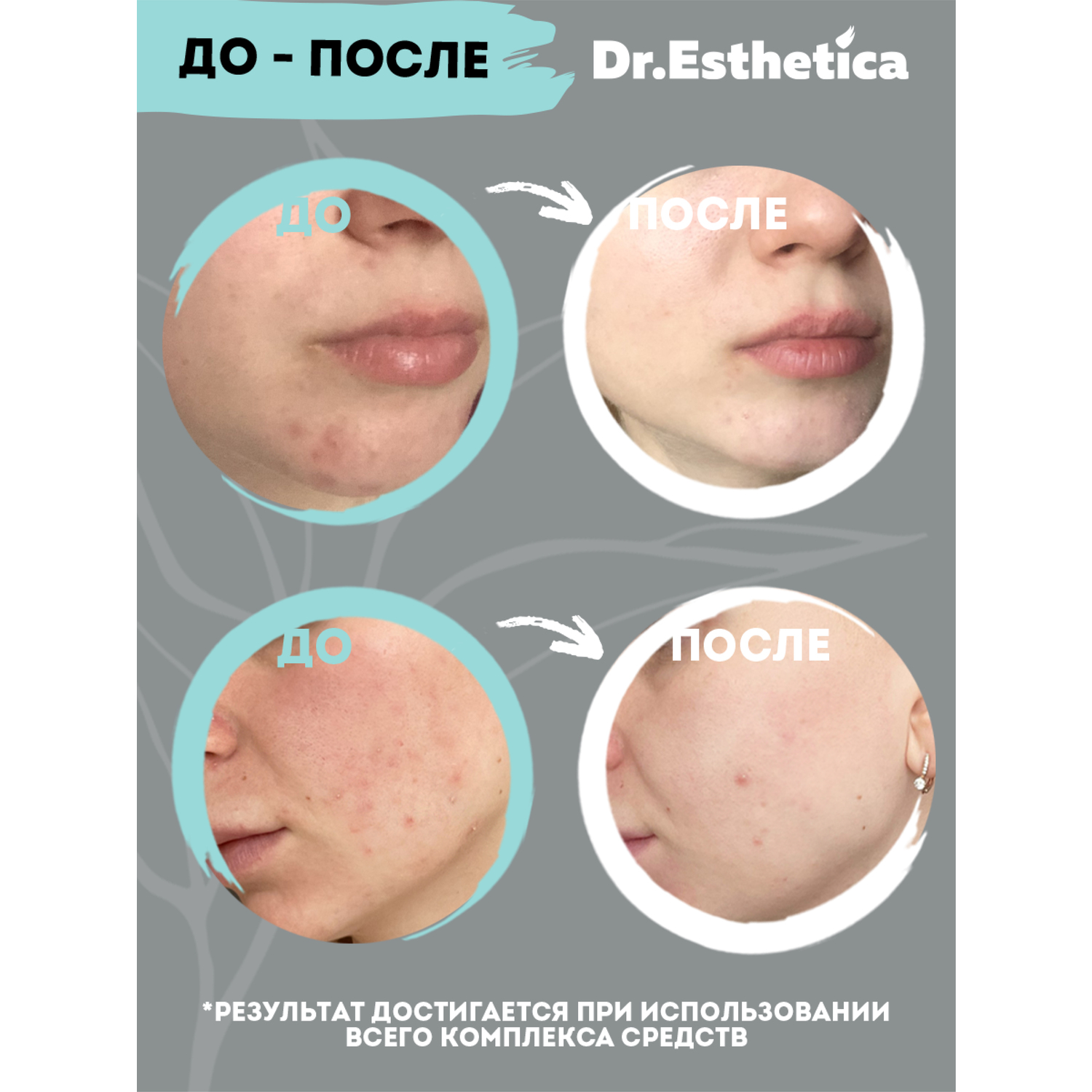 фото Гель-корректор dr. esthetica no acne adults 15 мл