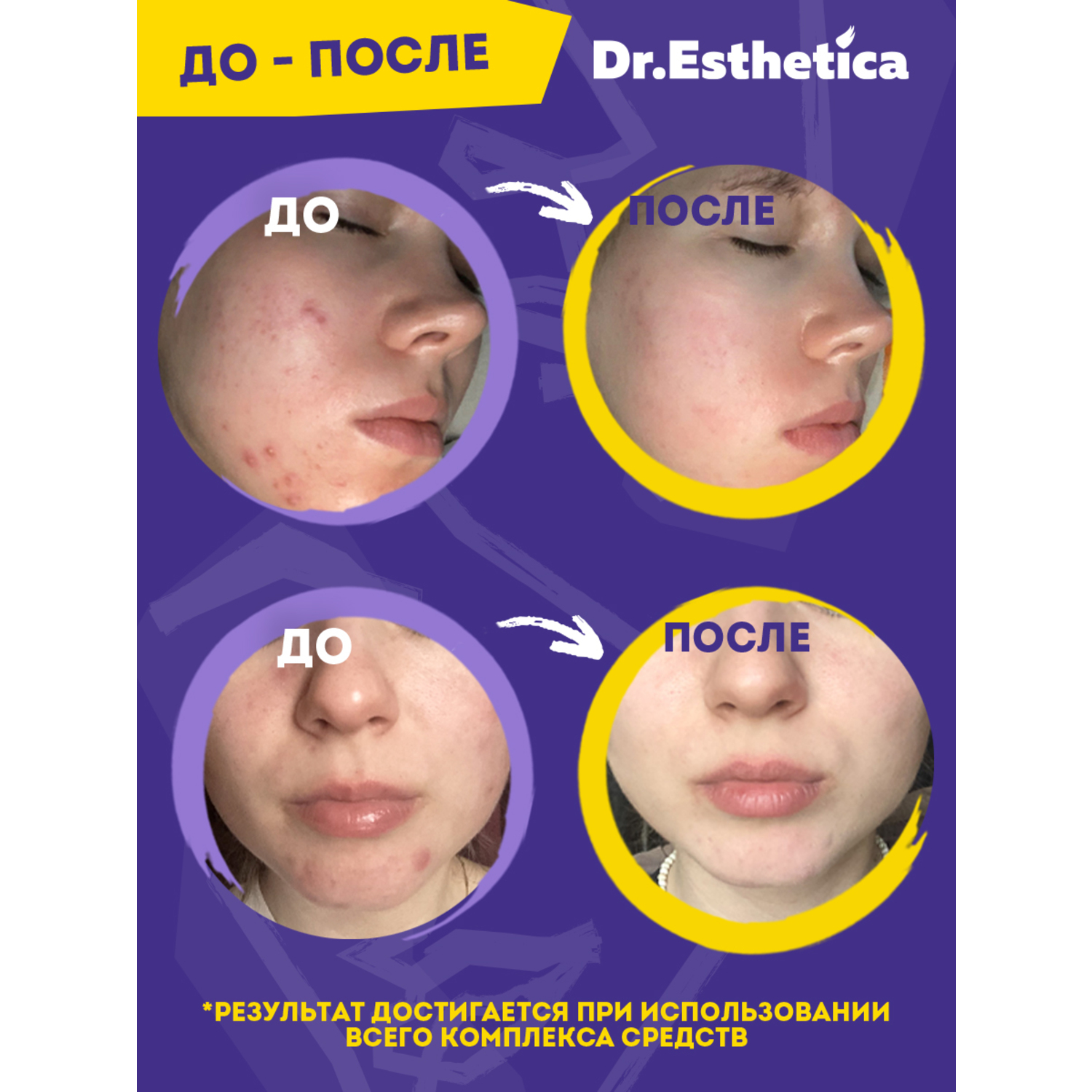 фото Очищающая пенка-актив dr. esthetica no acne teens 200 мл