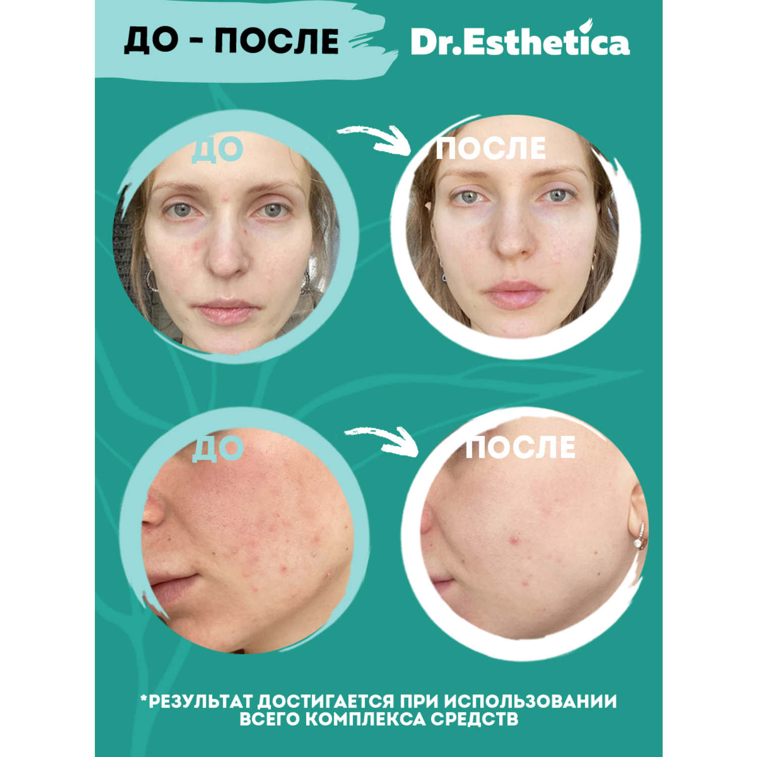 фото Очищающая пенка-баланс dr. esthetica no acne adults 200 мл